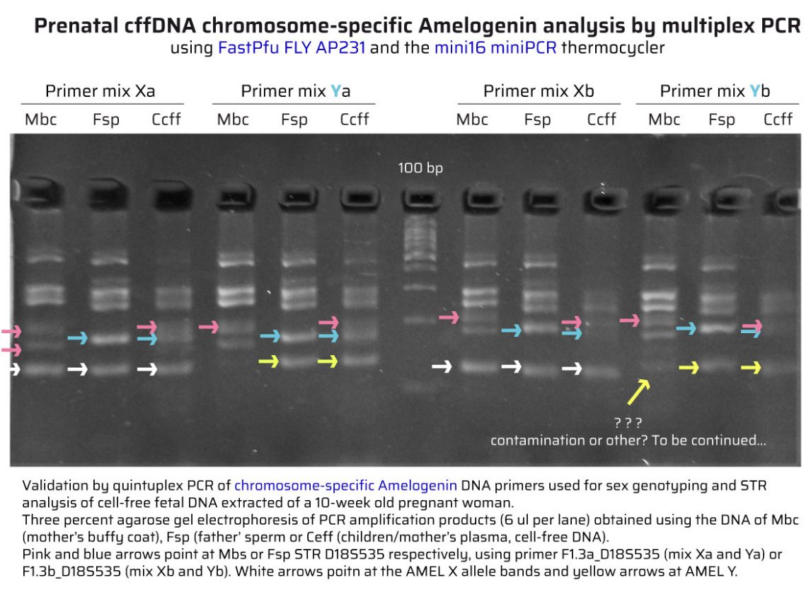 PCR with chromosome-specific Amelogenin DNA primers